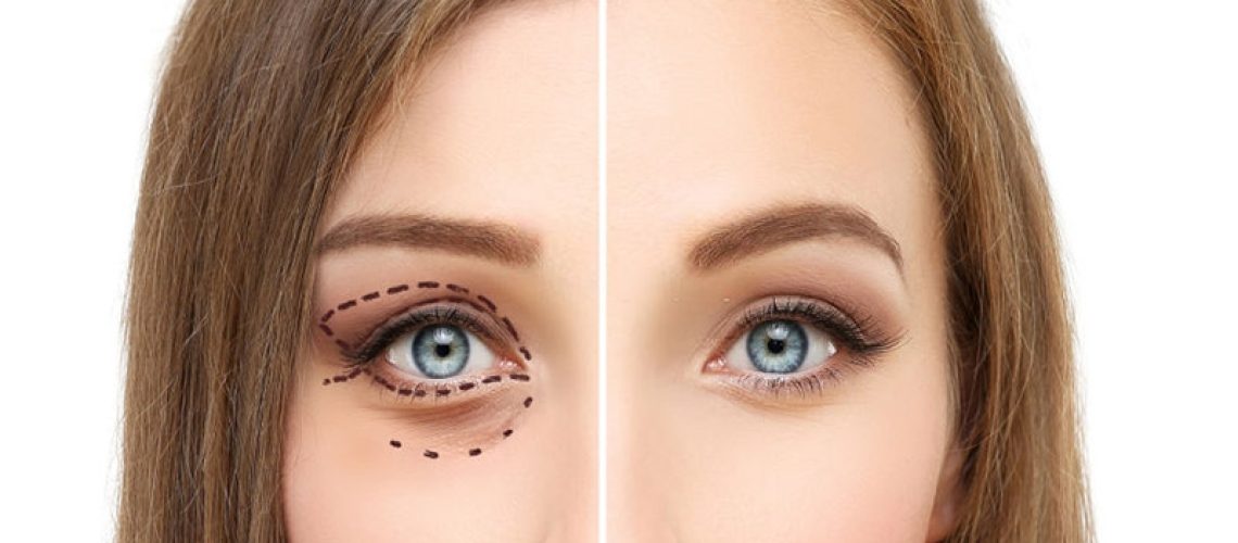 بهترین دکتر بلفاروپلاستی در تهران