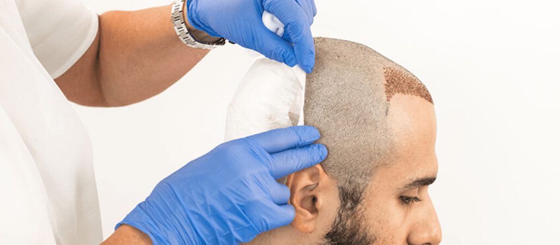 بهترین دکتر کاشت مو